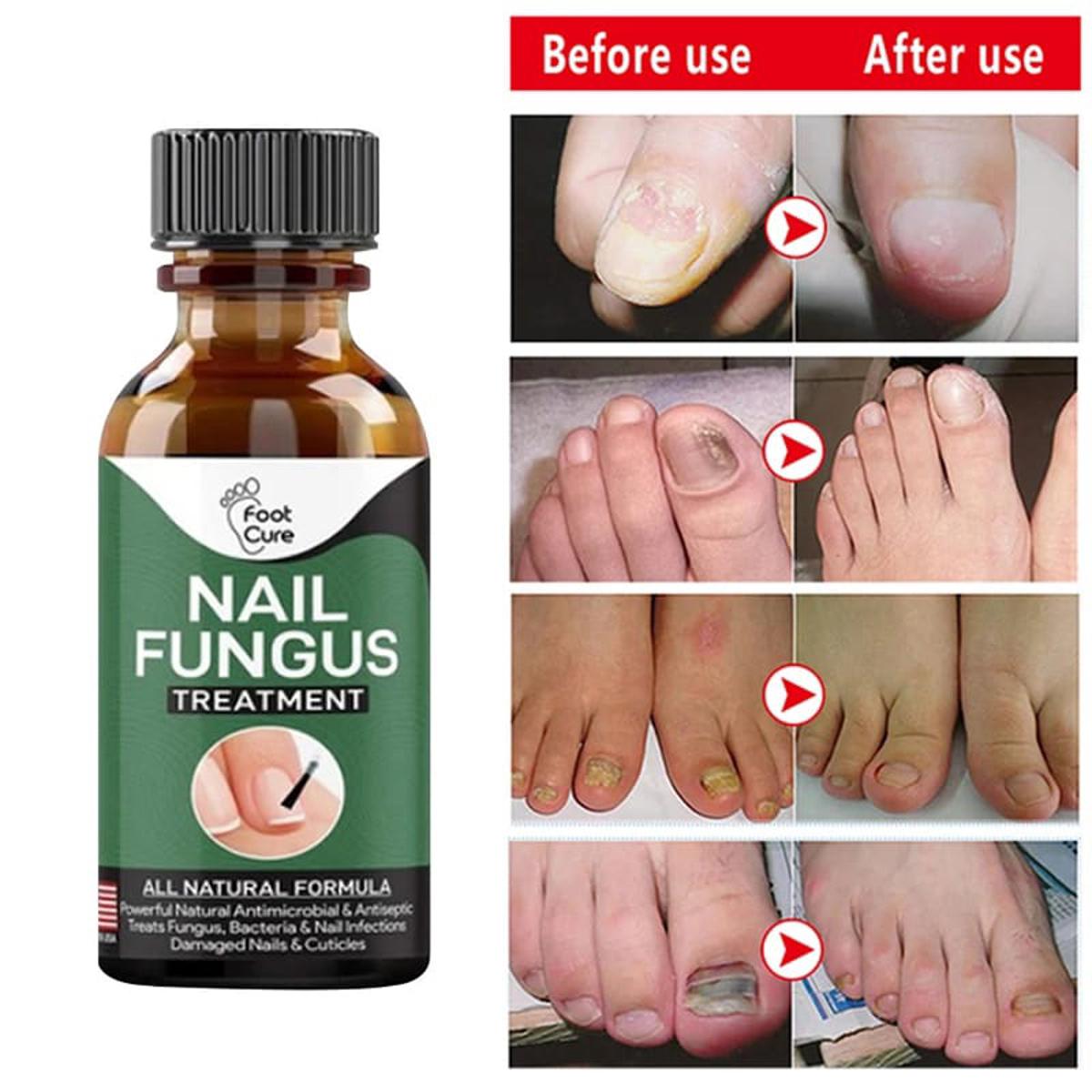 Nail Fungus Solution