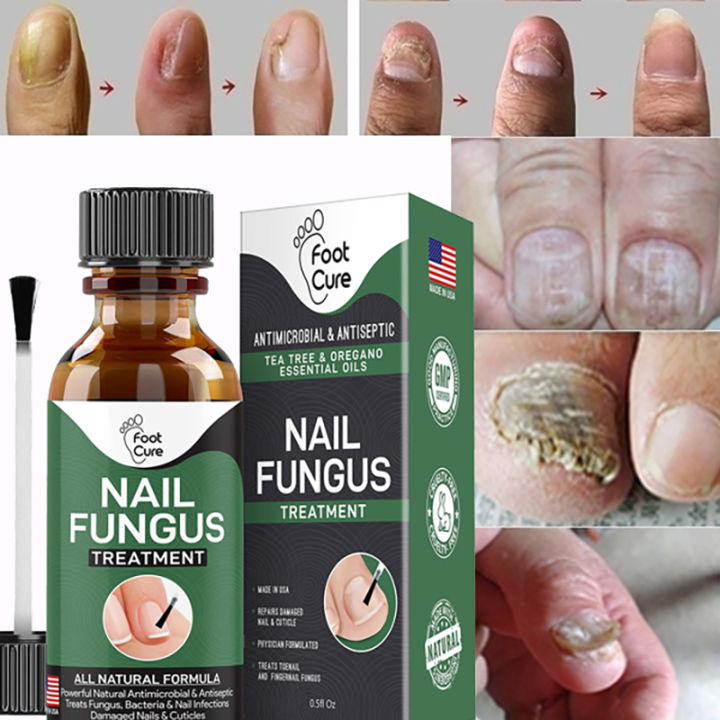 Nail Fungus Solution